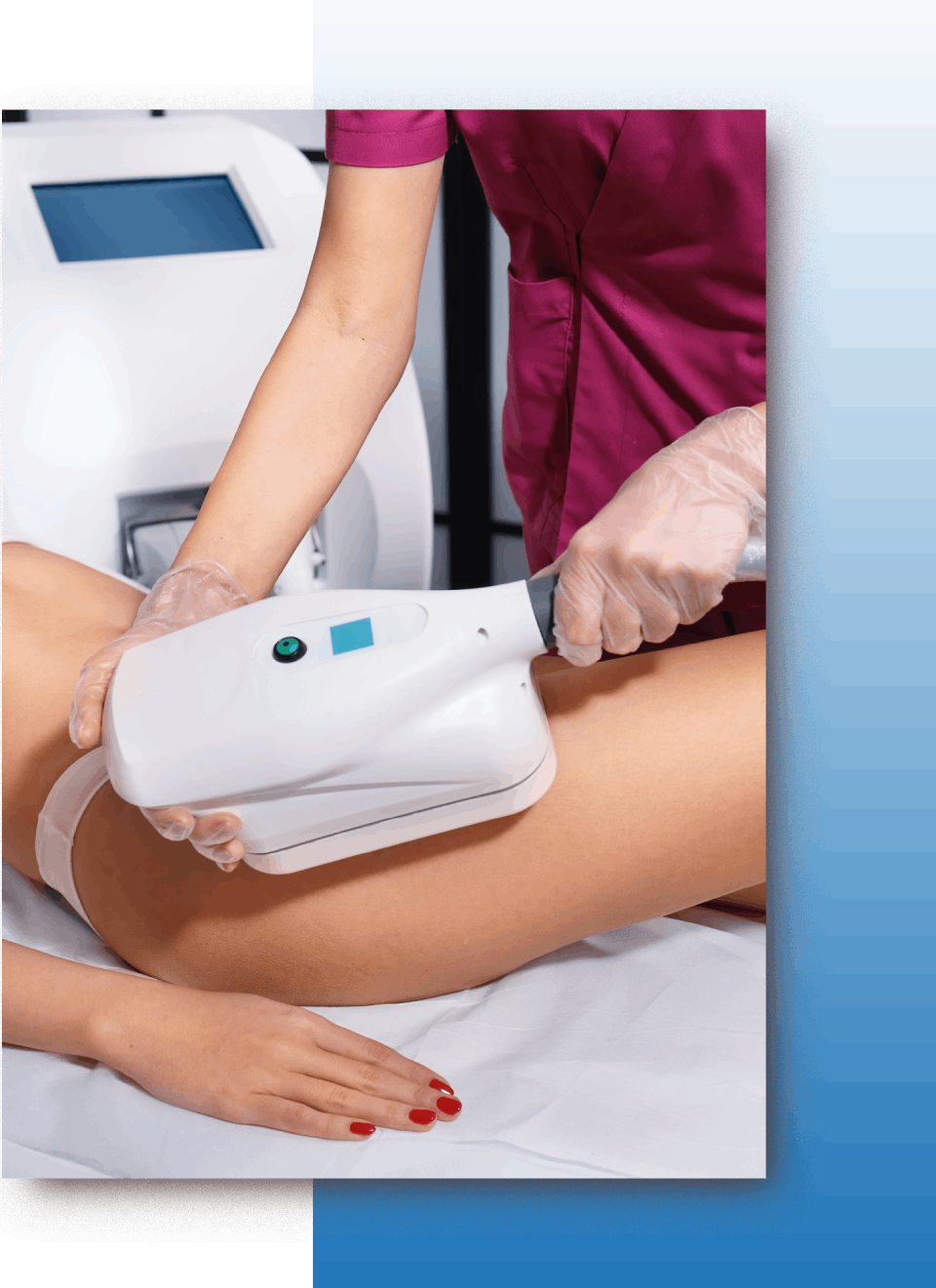 soin de cryolipolyse